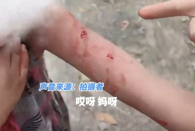 女孩被野猴咬伤,母亲:去打野猴还咬着不放_新闻频道_中华网