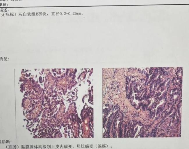 ​74岁阿姨常吃腌制品患上直肠腺癌 家人震惊：都这么养生了怎么会？