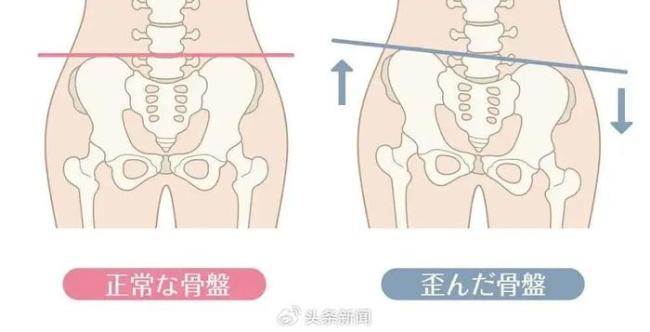 超80%的人骨盆都不正 揭秘人体“最贵容器”的隐忧与挑战