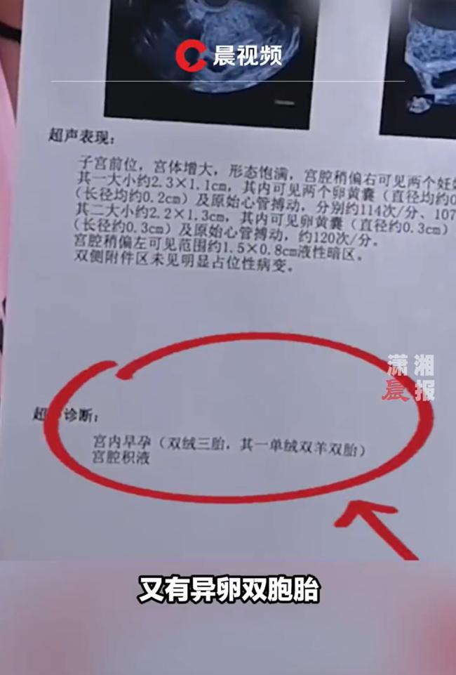 不孕女子喜获3胞胎同卵异卵同出现 医生惊呼第一次见