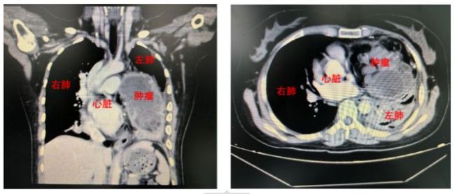 女子大量咳血体内有个20岁肿瘤 竟是童年遗留畸胎瘤作怪