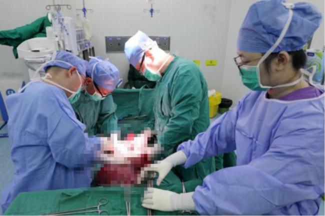 女子腹部鼓起 体内藏巨大“包块” 25斤肿瘤成功切除