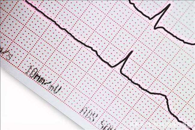 症状不在心脏为何还要做心电图 全面解读心电图检查的重要性