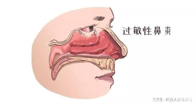 过敏性鼻炎会随年龄增长自愈吗？秋季防范攻略