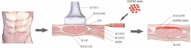 世界首例！我国学者利用干细胞成功治疗1型糖尿病 开辟医疗新纪元