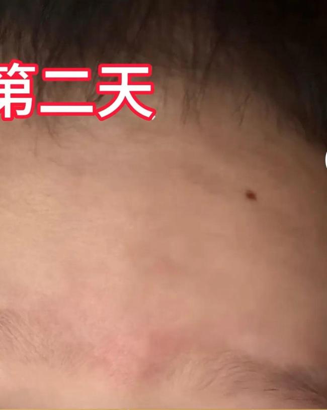 宝妈用狗尾巴草给孩子点痣惊呆网友 传统VS现代的育儿抉择