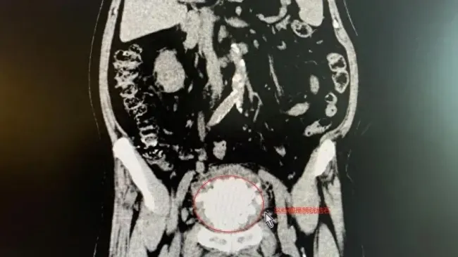 87岁老东说念主膀胱惊现近300颗结石