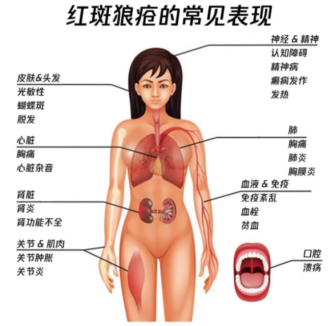 女子患红斑狼疮赴瑞士选择安乐死 首位公开获批的中国内地华人