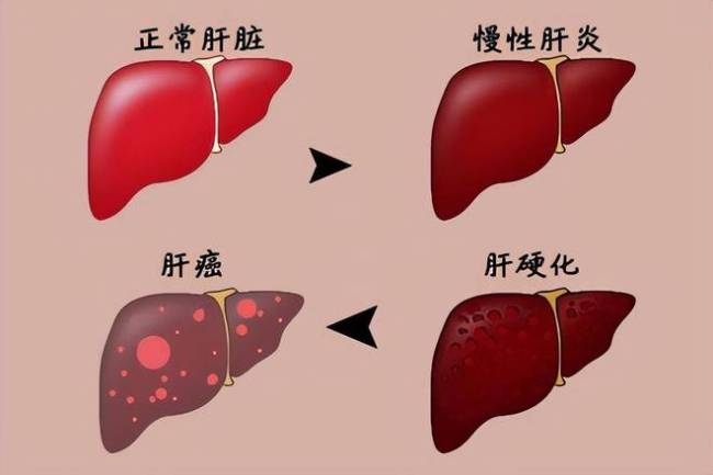 肝硬化并不是毫无预兆，若有这几个极端赶快上病院，早了解早戒备 警惕肝脏“千里默杀手”