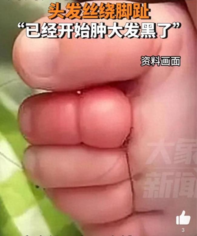 女婴脚趾被头发缠绕发现时已肿大