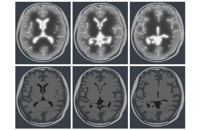 做一次CT,，對身體的傷害有多大？多少次會致癌,？告訴你大實話