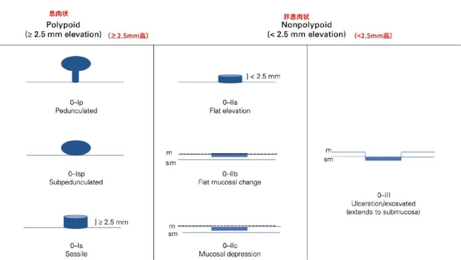 這些位置長了息肉要當(dāng)心,！尤其這種幾乎100%會(huì)癌變