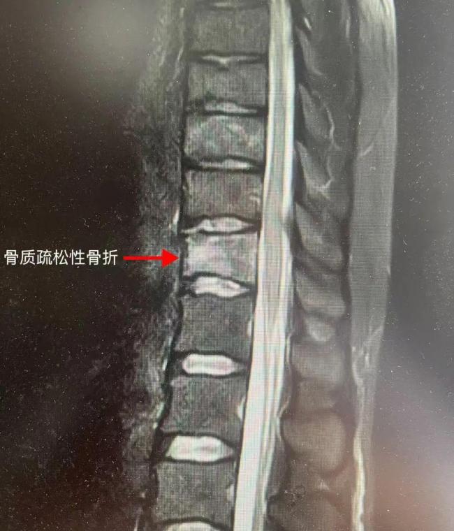 女子每天喝4杯咖啡骨质疏松 过量咖啡影响钙吸收