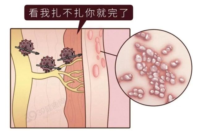 醫(yī)生提醒單純皰疹一旦感染終身攜帶 警惕神經(jīng)痛折磨