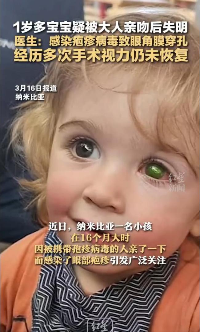 1歲多寶寶疑被大人親吻后失明 孢疹病毒引發(fā)眼部感染