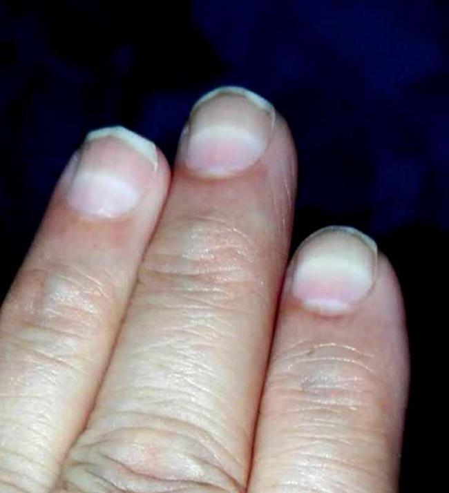 3歲女童突然脫發(fā) 查出鉈中毒 鉈中毒癥狀明顯