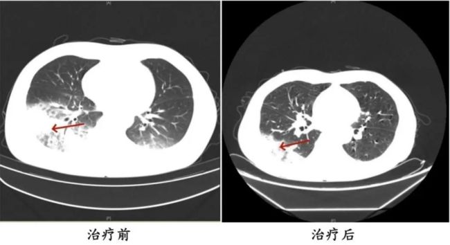 吹了3天空調(diào)，男子左肺“白”一半,！專家緊急提醒
