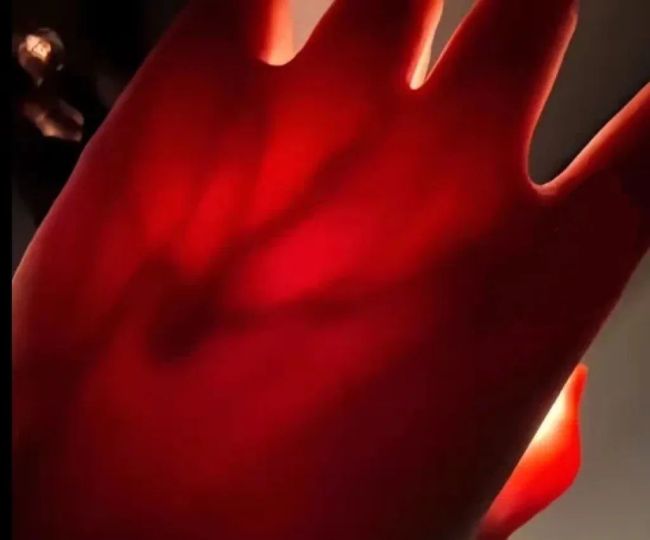 女生曬照被網(wǎng)友看出血管瘤 網(wǎng)友：默默打開手電筒