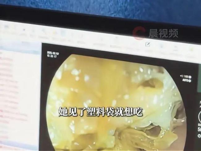 10歲女孩患“長發(fā)公主綜合征” 罕見病例引關(guān)注
