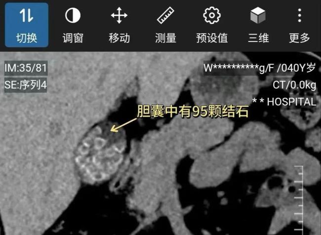 一女子體內(nèi)查出近百顆結(jié)石 不良生活習(xí)慣成“罪魁禍?zhǔn)住?></p><p>膽囊是儲存和濃縮膽汁的器官，需要消化食物時,，膽囊收縮排出膽汁,。如果早上不進(jìn)食，膽汁無法排出,，在膽囊內(nèi)不斷濃縮,，會析出晶體附著在膽囊壁上，逐漸形成膽囊結(jié)石,。醫(yī)生建議,，最好在早晨6到8點進(jìn)食早餐。即使因為工作原因難以按時吃早餐,，喝一杯水也有較大幫助,。除了不吃早餐，高脂肪,、高膽固醇飲食,，以及肥胖、久坐等生活方式都可能增加患膽囊結(jié)石的風(fēng)險,。預(yù)防勝過治療,，按時吃早餐，飲食上做到少油,、少膽固醇,、不過量攝入食物，并結(jié)合運(yùn)動,，能較好地預(yù)防膽囊結(jié)石,。</p>
            </div>
            <!-- /qudao/etc/endpage/ep_pagetop.shtml Start -->
<div   id=