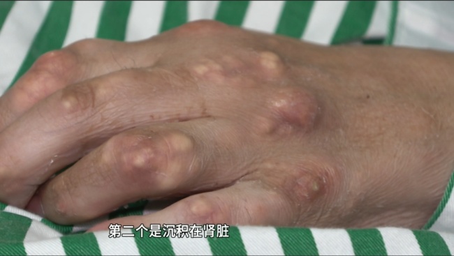 33歲男子竟患痛風(fēng)15年 飲料成“罪魁禍?zhǔn)住?></p><p>最近,，各大外賣(mài)平臺(tái)紛紛推出優(yōu)惠活動(dòng)，如“幾塊錢(qián)一杯奶茶”,、“每天睜眼就是滿(mǎn)減”,。面對(duì)這種“甜蜜煩惱”，不少年輕人成為“外賣(mài)商戰(zhàn)”的第一波“受害者”,。醫(yī)生指出,，越來(lái)越多的年輕人成為痛風(fēng)的高發(fā)人群，建議市民養(yǎng)成良好的飲食和生活習(xí)慣,，避免痛風(fēng)侵襲,。</p>
            </div>
            <!-- /qudao/etc/endpage/ep_pagetop.shtml Start -->
<div   id=