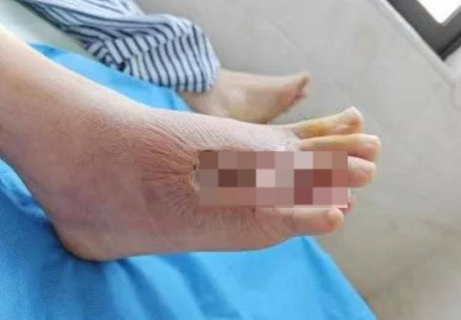 男子在沙發(fā)上睡了一覺險截趾 蟲咬引發(fā)嚴重感染