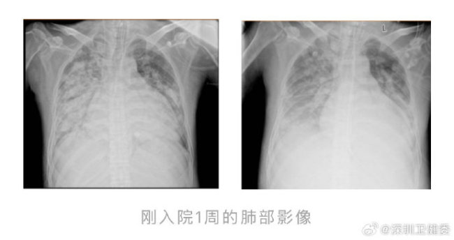 小伙高燒不退肺被“燒白”進(jìn)ICU，感染超級耐藥菌差點(diǎn)沒命,！