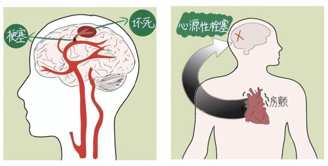34歲網(wǎng)紅村花突發(fā)急性腦梗去世 年輕生命猝然離去