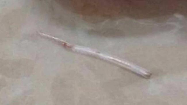 泰国女子鱼刺卡喉按摩痛处刺穿脖子 小小鱼刺引发大危机