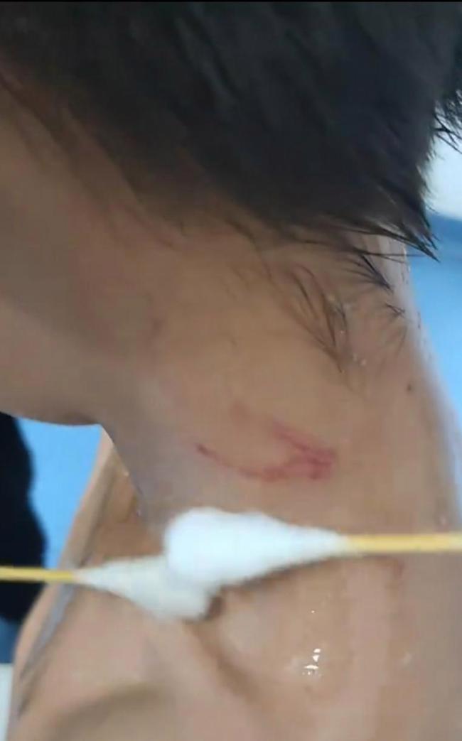 男孩对小猴竖中指遭猴子群殴 公园承诺报销疫苗费用