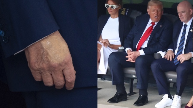 美國總統特朗普被確診患靜脈疾病