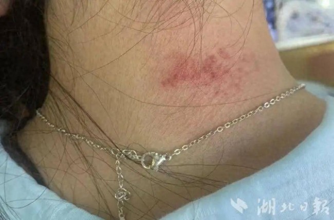 女子戴项链引发“首饰病” 珠宝佩戴需谨慎，“美丽首饰”致皮肤困扰