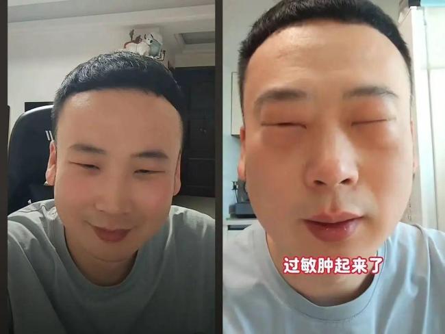 男子吃蝉蛹过敏眼睛肿成“奥特曼”