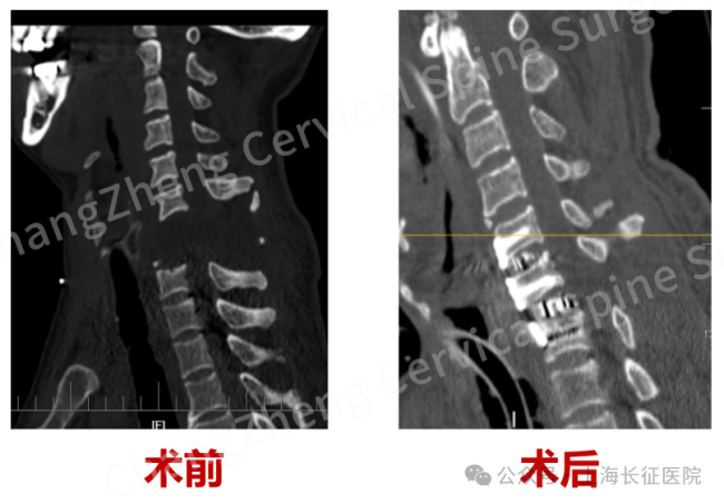 全球罕见！“身首离断”患者被救回 中国医生挑战“不可能”