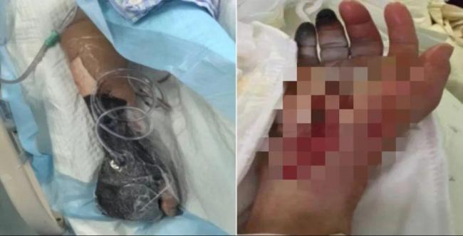 6岁男孩赤脚在沙滩踩到死鱼后住进ICU 警惕创伤弧菌感染