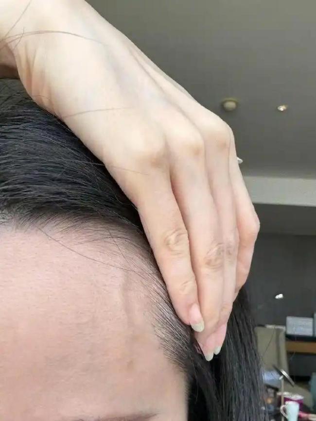 张靓颖自曝患病 伸懒腰手掌流血十年