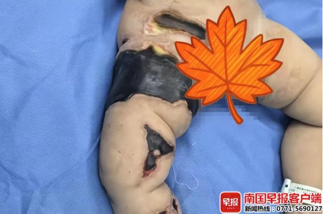 女婴被不知名虫子叮咬确诊脓毒血症多器官衰竭，命悬一线