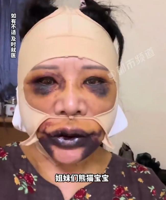 58岁女子整容后肿成熊猫 追求美丽需谨慎