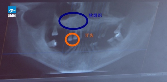 44岁女子牙齿快掉光 医生提醒 牙周炎需早治