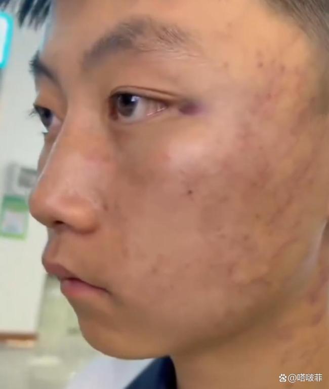 媒体评老师打学生致多处淤痕 教育方式引争议