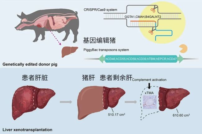 全球首例！中国团队成功将猪肝移植给活人 突破性进展开启新希望