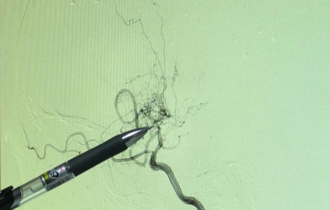 6岁女童与哥哥争抢手机后突发脑梗 罕见病症惊现儿童