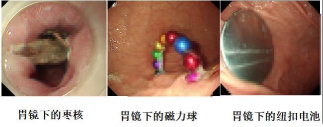 真吞金兽！11岁孩子为锻炼舌头吞下10克金豆