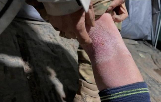 男子荒野求生32天后退赛像极流浪汉 冻伤逼退