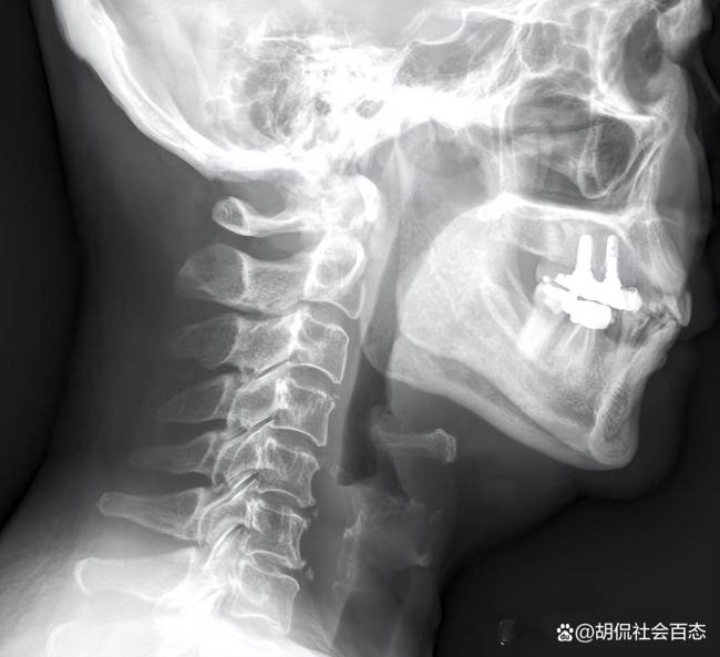 男子中午吃一条鱼 下午上班死亡