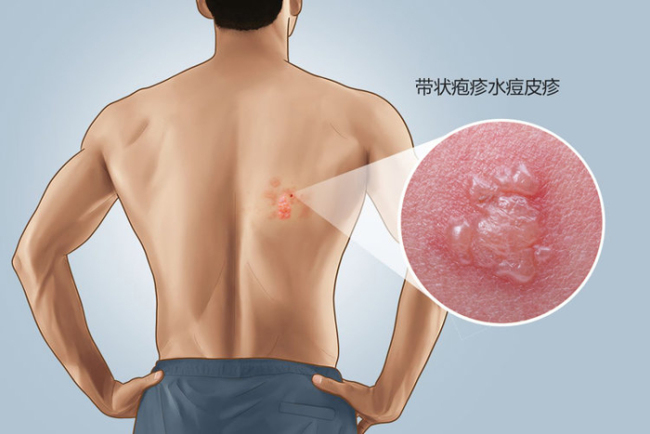 斯坦福研究：几乎人人携带的这种常见病毒，是红斑狼疮元凶