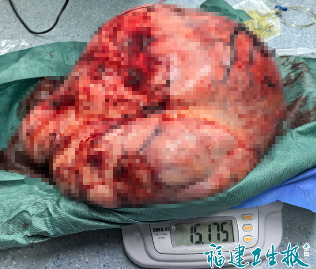 女子因忌医“疙瘩”拖7年未治变巨瘤 七年“鸵鸟心态”养出“庞然大物”