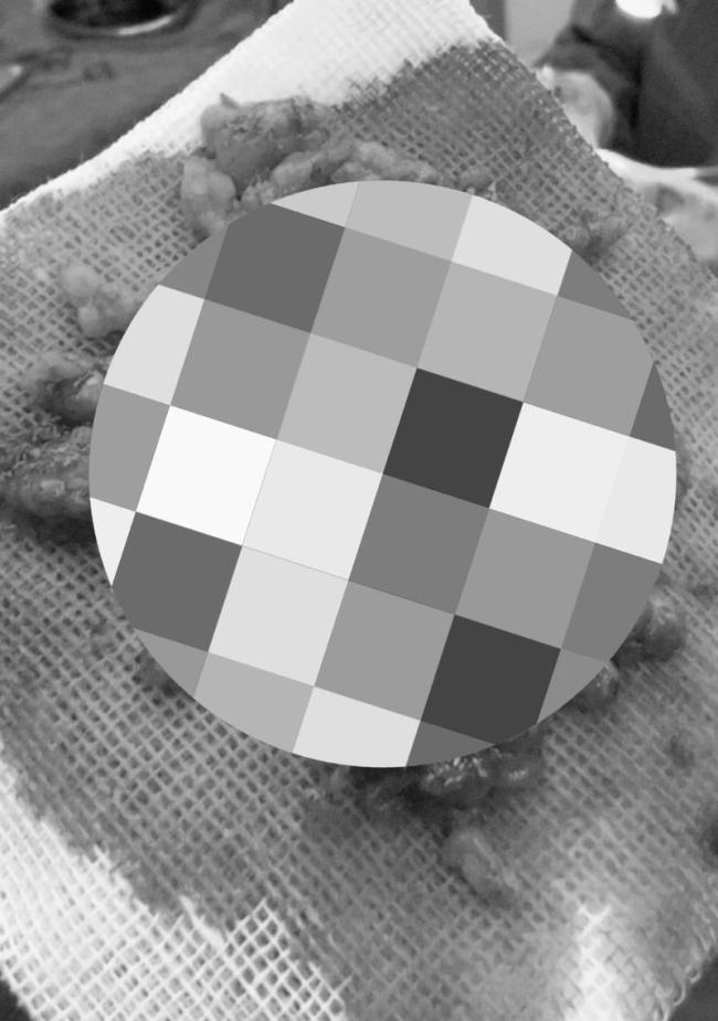 成本20元的表皮生長(zhǎng)因子售價(jià)上萬 非法注射引發(fā)面部毀容