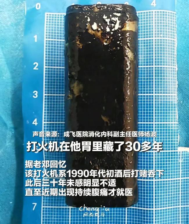 男子酒后吞下打火机30年后取出已泡黑