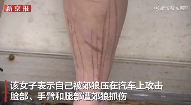 美国一女子自称在家门口遭郊狼袭击 罕见事件引发关注